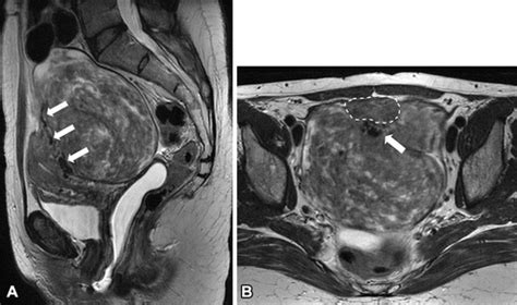 Smooth Muscle Tumors Of The Uterus At Mri Focus On Leiomyomas And Figo Classification