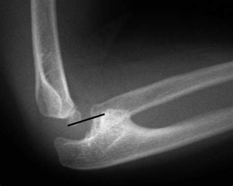 Nursemaid Elbow Revisited And A Review Of Congenital Radioulnar