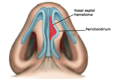 Nasal Septal Hematoma Treatment Management Point Of Care