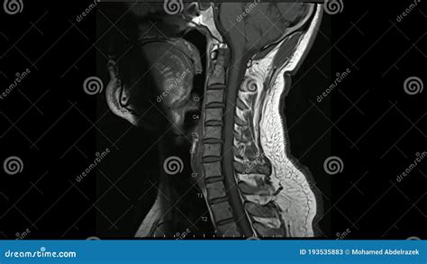 Magnetic Resonance Images Of Cervical Spine Sagittal T1 Weighted Images