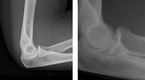 Coronoid Process Of Ulna Fracture