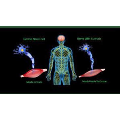 Lateral Sclerosis Treatment in Noida by Homoeopathic World | ID ...