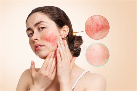 Portrait Of A Young Caucasian Woman Showing Redness And Inflamed Blood