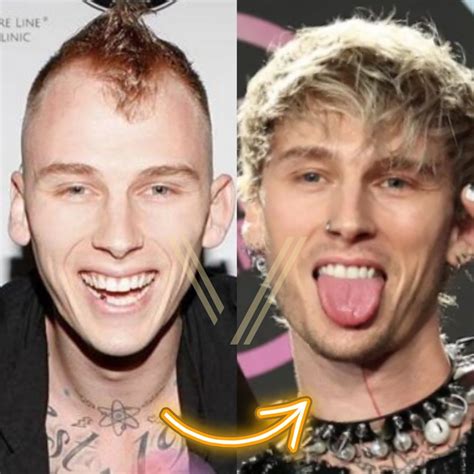 Mgks Hair Transplant Before And After Transformation