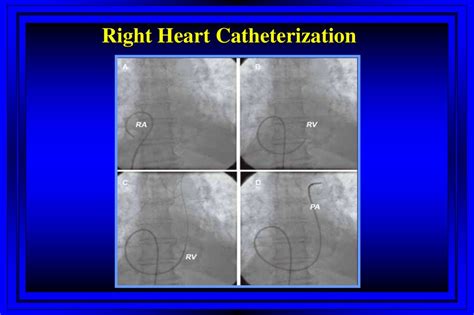 Right Heart Catheterization Swan Ganz Catheter презентация онлайн