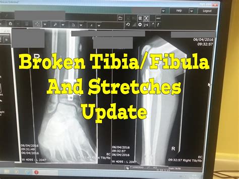 Broken Tibia Fibula Progress Update Xray And Stretches Youtube