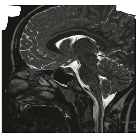 T2-weighted high-resolution image of the MRI brain anosmia protocol... | Download Scientific Diagram