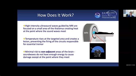 Focused Ultrasound For Essential Tremor And Tremor Dominant Parkinson S