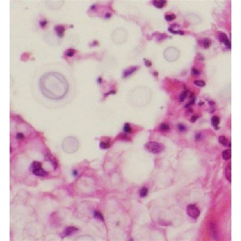 Pulmonary Cryptococcosis A Pulmonary Nodule 12 × 10 Cm In Diameter Download Scientific