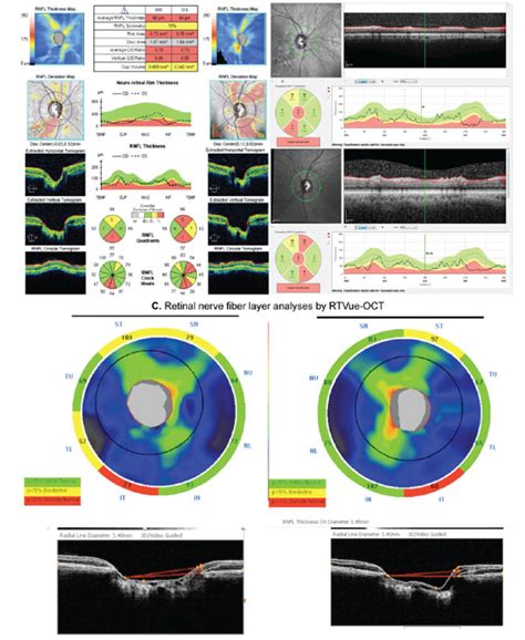 Spectral Domain Optical Coherence Tomography For Glaucoma Diagnosis