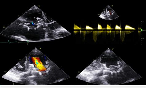 Echocardiogram Images At Follow Up Showing A Wellfunctioning