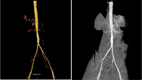 Computed Tomography Angiography With Runoff Showing The Stented Segment