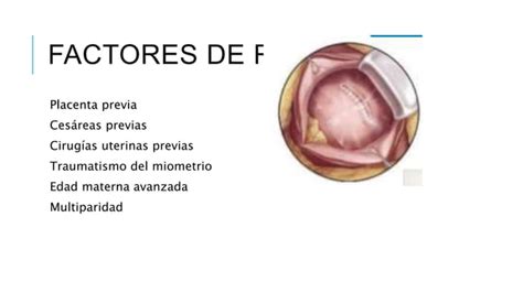 Acretismo Placentario Ppt