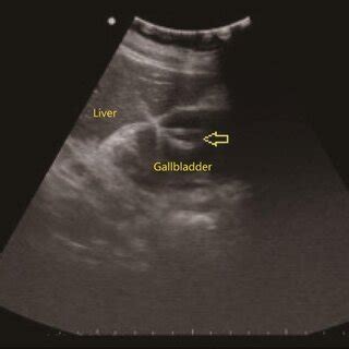 Image Of Ultrasound Guided Percutaneous Transhepatic Gallbladder