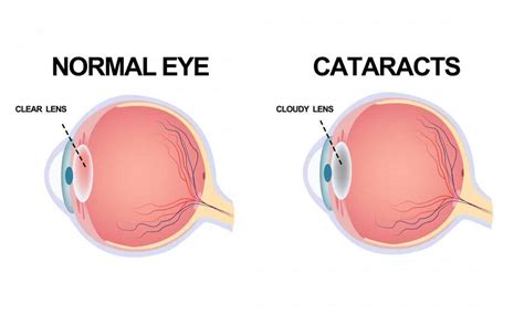 Understanding The 3 Different Types Of Cataracts Vision Center Of New