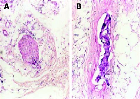 Figure 1 From Pathological Study Of Distal Mesorectal Cancer Spread To