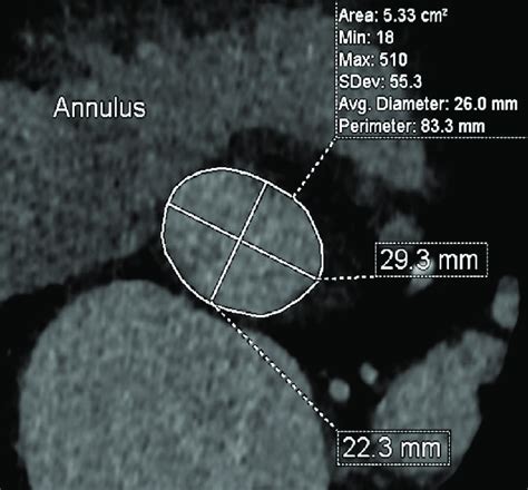 Aortic annulus measurements. | Download Scientific Diagram