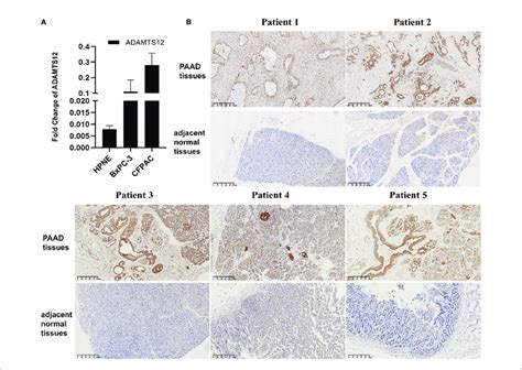 Validation Of Adamts12 Expression A Qrt Pcr Results Of Adamts12