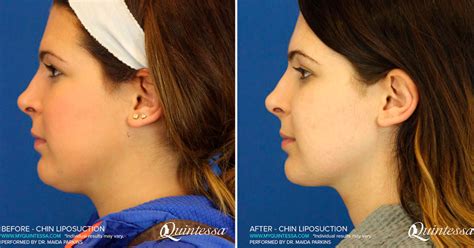 Chin Augmentation Implants | Milwaukee & Madison | Quintessa