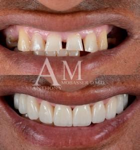 Revolutionizing Smiles In Los Angeles The Rise Of Zirconia Veneers In