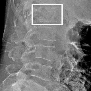 Annotated Ap Lumbar Spine Radiograph A Vertebral Body B Spinous