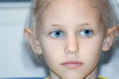 Retinoblastoma Symptoms Causes And Treatment Step To Health