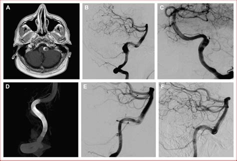 Incidental Finding Of A Partially Thrombosed Aneurysm Of The Left