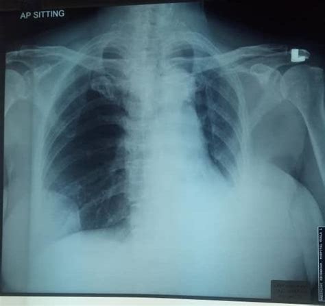 Chest X Ray The Chest Radiograph Showed Figure Decreased Left Lung