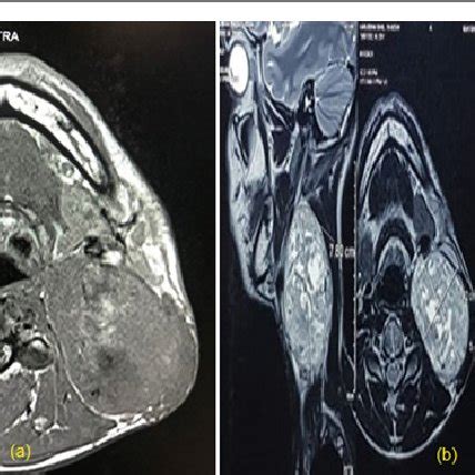 a) MRI images of left neck schwannoma; b): MRI showing a large ...