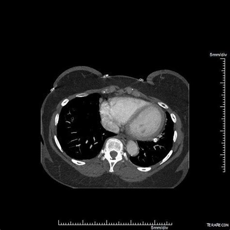 Pulmonary Avm Embolization With Amplatzer Plug Eurorad