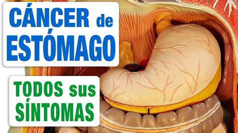 Todos Los Síntomas Del Cáncer De Estómago Youtube