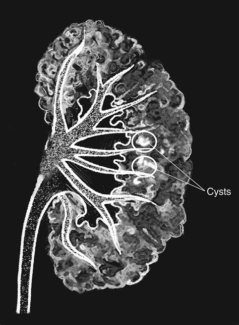 Medullary Sponge Kidney Wikipedia