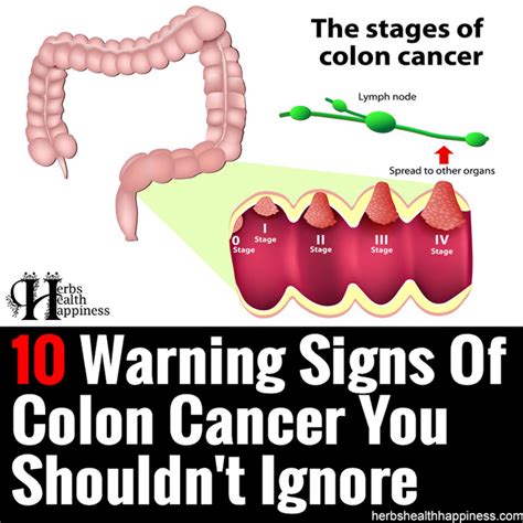 10 Warning Signs Of Colon Cancer You Shouldnt Ignore Herbs Health