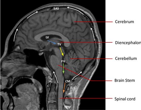 Normal Sagittal Brain Mri