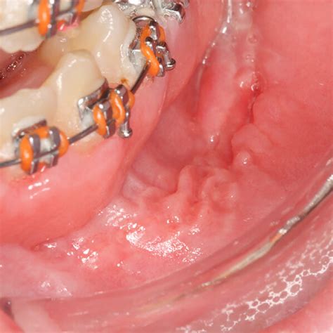 Amyloidosis A Macroglossia With Characteristic Crenations Along