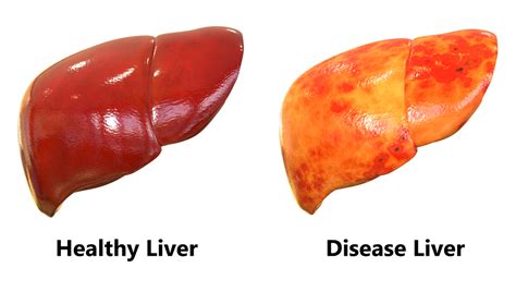 Fatty Liver - LapSurgery.ae