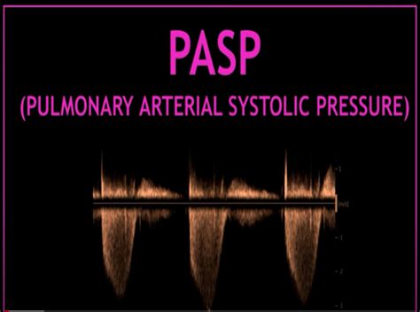 Pasp Pulmonary Artery Systolic Pressure Perfusfind