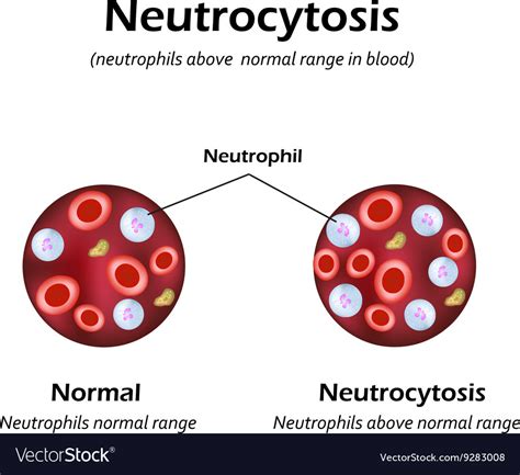 Neutrophils were above the normal range Royalty Free Vector