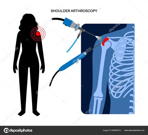 Shoulder Arthroscopy Procedure Rotator Cuff Tears Shoulder Impingement ...