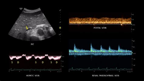 Small Inferior Vena Cava And Normalized Venous Doppler Waveforms