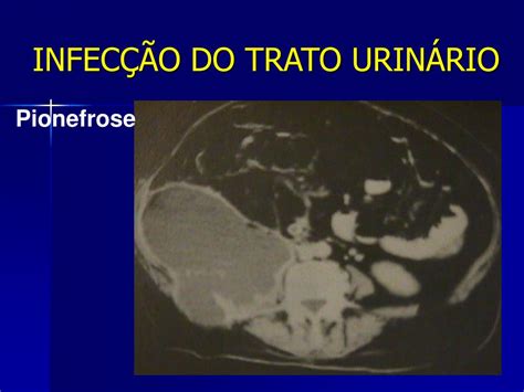 PPT INFECÇÃO DO TRATO URINÁRIO PAULO OLIVEIRA PowerPoint Presentation