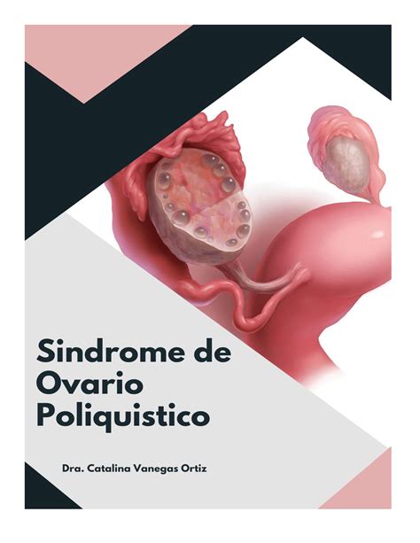 SOP apuntes Introducción El Síndrome de Ovario Poliquístico SOP