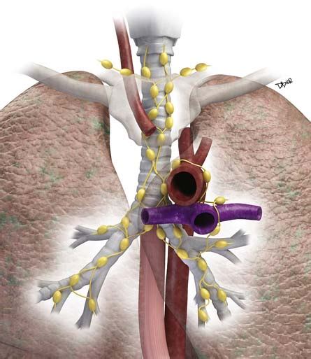 Pleural Tumors Radiology Key