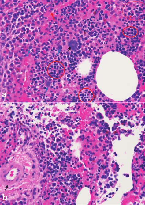 A Biopsy Of Presacral Mass Demonstrates Nhs Emh With Trilineage