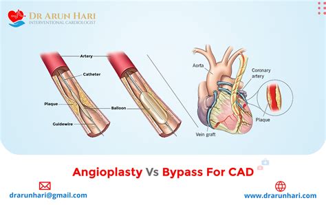 Angioplasty Vs Bypass For Cad Dr Arun Hari