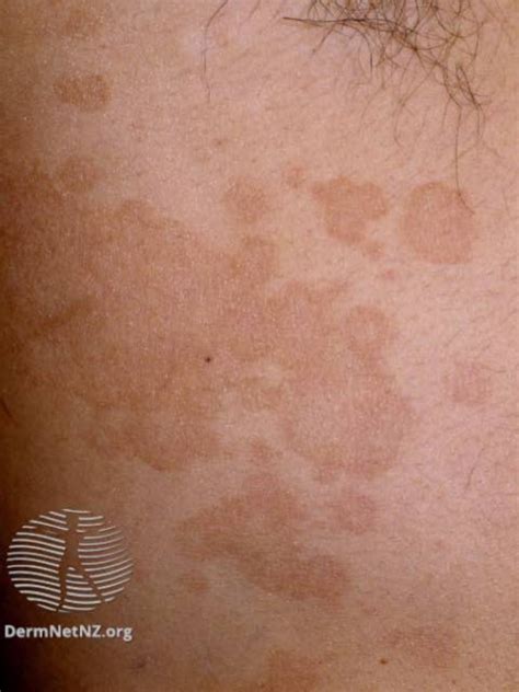 All About Tinea Versicolor Causes Treatment And Prevention 50 Off