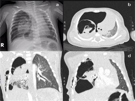 Chest X Ray A And Ct B C D Showing The Presence Of Right