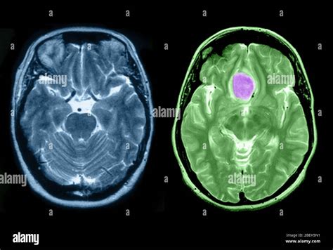 Meningioma Benigno Immagini E Fotografie Stock Ad Alta Risoluzione Alamy