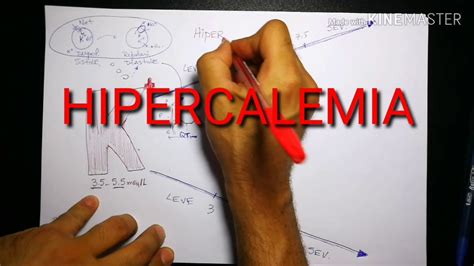 Ecg Hipocalemia Hipercalemia Youtube