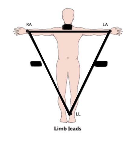 Topic Einthoven Triangle Einthoven Law Flashcards Quizlet